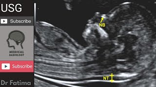 Fetal Nuchal translucency amp Nuchal fold ultrasound by DrFatima [upl. by Nilpik]