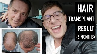 Hair Transplant After 6 Months Growth  Dads Reveal [upl. by Atiuqihc]