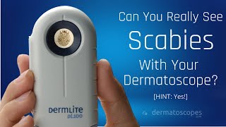 Dermoscopy for Scabies [upl. by Vizzone344]