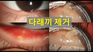 다래끼 제거 영상 Chalazion removal [upl. by Esilana]