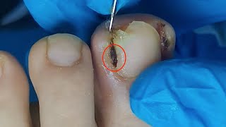 【Daily Pedicure Tutorial】Removing Deeply Embedded Ingrown Toenails on Both Sides of The Big Toe [upl. by Eiba720]