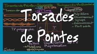 Torsades de pointes ECG symptômes causes et traitement [upl. by Bechler399]