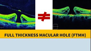 MACULAR HOLE BASICS amp PATHOPHYSIOLOGY [upl. by Amyas]