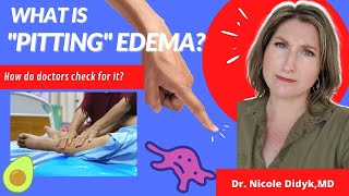 What is quotpittingquot edema How do doctors check for it GERIMinute 179 [upl. by Ailaro]