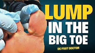 Lump In The Big Toe [upl. by Fleurette]