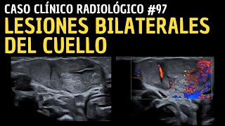 Caso clínico 97 Lesiones Bilaterales del Cuello [upl. by Ferretti]