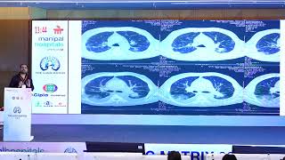 Dr P Vishnu Rao Consultant Infectious Diseases specialist talk at THE LUNG MATRIX conference [upl. by Haddad]