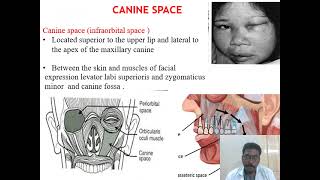 Head amp neck space infections  Oral Maxillofacial surgery  Dr Arun Krishnan  SBDCH [upl. by Ganley]