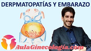 DERMATOPATÍAS Y EMBARAZO ERUPCIÓN POLIMORFA PENFIGOIDE ATOPIA  Ginecología y Obstetricia [upl. by Drawoh]