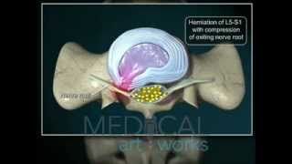 3D Medical Animation  L5S1paracentraldischerniation with compression of nerve root [upl. by Radec425]