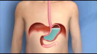 Heartburn Acid Reflux GERDMayo Clinic [upl. by Erodroeht]