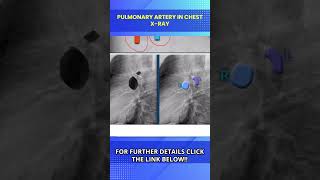 Chest X Ray Lateral View Normal amp Positioning Chest X Ray Kaise Hota Hai [upl. by Schwing]