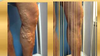 Varicose vein before and after Part 3  varicose vein treatment varicose surgery [upl. by Glennon]