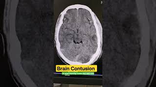 Brain Contusion Cerebral [upl. by Acnalb204]