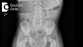 How to diagnose Intussusception  Dr Nagaraj B Puttaswamy [upl. by Tichon]