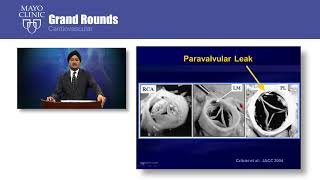 CV Grand Rounds – Transcatheter Aortic Valve Replacement [upl. by Abate]