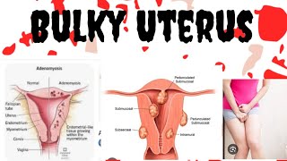 Bulky UterusfibroidsAdenomyosisusg report shows Bulky uterus [upl. by Pretrice278]