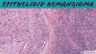 Epithelioid Hemangioma aka ALHE 5Minute Pathology Pearls [upl. by Mcgurn662]