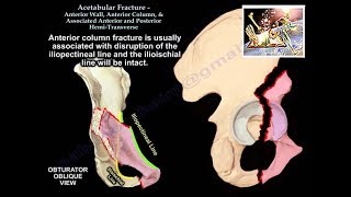 Acetabulum Anterior Wall Column HemiTransverse  Everything You Need To Know  Dr Nabil Ebraheim [upl. by Ueik]