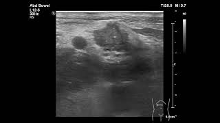 metastatic lymphadenopathy [upl. by Sanders]