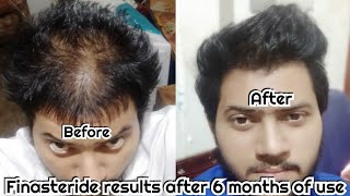 Finasteride results after 6 months Finasteride awesome results Case  study Finasteride [upl. by Gina]