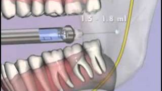 Medical Videos Malamed s Local Anesthesia 10 Mandibular Injections flv [upl. by Amme]