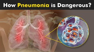 What Happens in Pneumonia  Symptoms Causes and Treatment 3D Animattion [upl. by Maddie448]