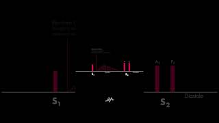 Pulmonic Stenosis [upl. by Phillie]