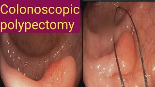 Colonoscopic polypectomy l l Endo Cut [upl. by Emily]