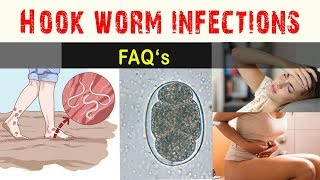 Hook worm Infections  FAQ and Answers [upl. by Sinne]