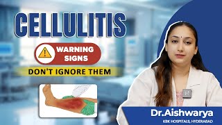 Cellulitis Alert  Dont Ignore These Cellulitis Symptoms  Dr Aishwarya  KBK Hospitals [upl. by Emmaline]