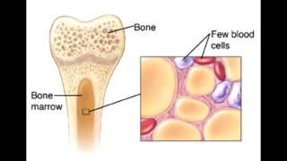 Aplastic Anemia amp Chronic Kidney Disease Related Anemia [upl. by Ennovad]