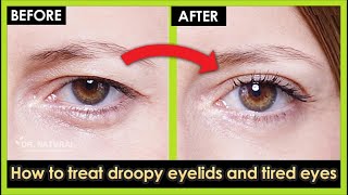 How to treat Droopy eyelids Sagging eyelids and Tired eyes Naturally at home 100 Work [upl. by Nosille353]