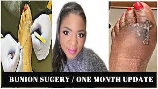 BUNION SURGERY PART 5  ONE MONTH UPDATE  VONDESSA J [upl. by Nevart]