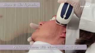 MeDioStar NeXT PRO  Training video for skin rejuvenation and whitening from Asclepion [upl. by Coughlin]