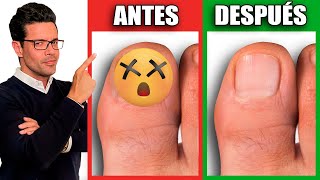 ¡Elimina HONGOS en las UÑAS en 1 DÍA  REMEDIOS NATURALES para HONGOS en las UÑAS [upl. by Neelie421]