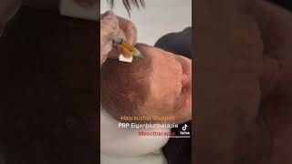 Haar Behandlung mit Mesotherapie oder PRP Eigenbluttherapie [upl. by Ricard]