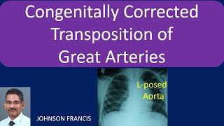 Congenitally Corrected Transposition of the Great Arteries [upl. by Frederique]