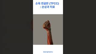 손목 연골판 삼각 연골 윤상체 TFCC  손상과 치료 [upl. by Suravart]