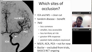 Endovascular clot retrieval for acute stroke statewide service protocol for Victoria [upl. by Beall]