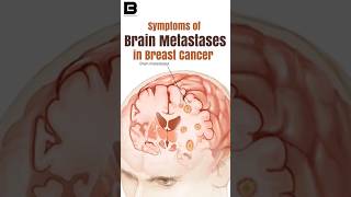 Symptoms Of Brain Metastases in Breast Cancer breastcancer [upl. by Laurella]