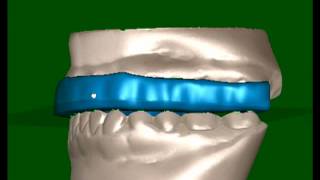 Digital TMJ Splint Fabrication by Great Lakes Orthodontics Ltd [upl. by Lamaj]