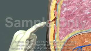 Thoracotomy  Normal Procedure [upl. by Fidel]