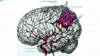 NEUROLOGIE HÉMORRAGIE MÉNINGÉE 2015 [upl. by Notnirt800]