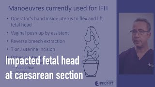 Impacted fetal head at caesarean section [upl. by Yaya]