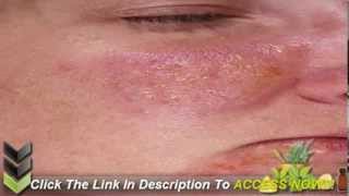 How to Cure Psoriasis Fast [upl. by Sugirdor]