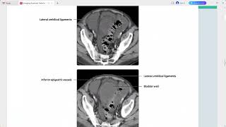 IMAGING ANATOMY ABDOMEN [upl. by Ariam]