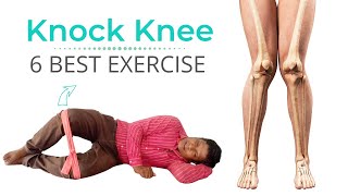 6 Best knock Knee Correction Exercise in Hindi [upl. by Erdrich]