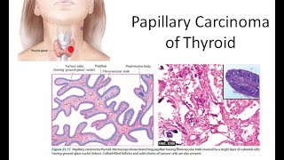 Pathology 818 a Papillary Carcinoma Thyroid Orphan Annie Eye Ground Lateral Aberrant psammoma bodies [upl. by Ayotl499]