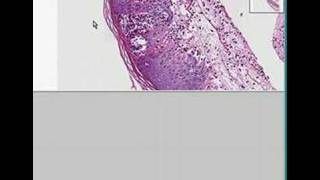 Histopathology SkinHerpes [upl. by Eselahc]